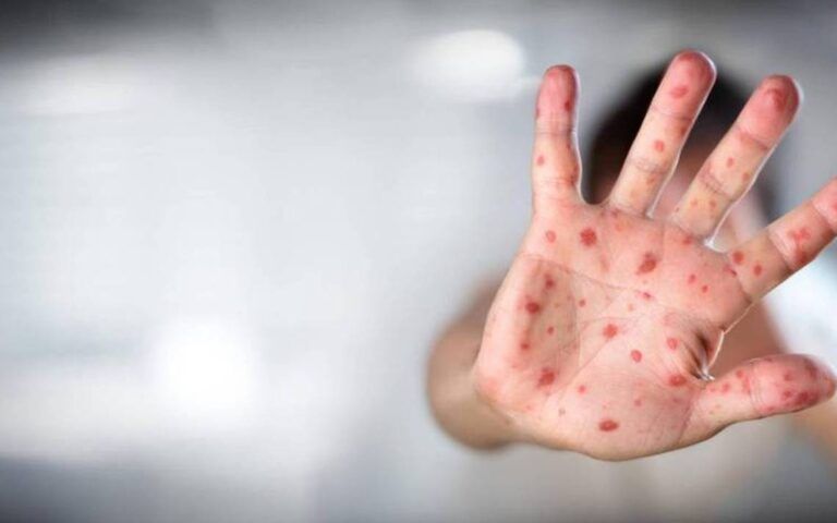 México Reporta 49 Casos de Viruela del Mono en 2024