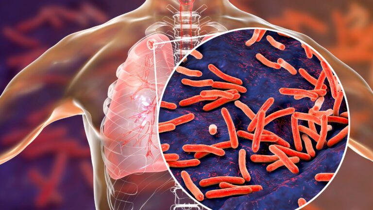 La tuberculosis se convierte nuevamente en la principal causa de mortalidad infecciosa a nivel mundial