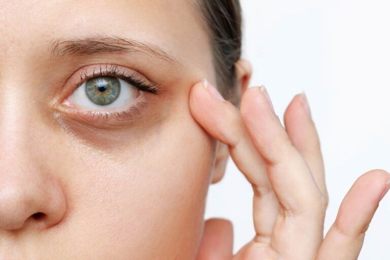 ¿Es posible revertir las ojeras? Descubre qué funciona y qué no